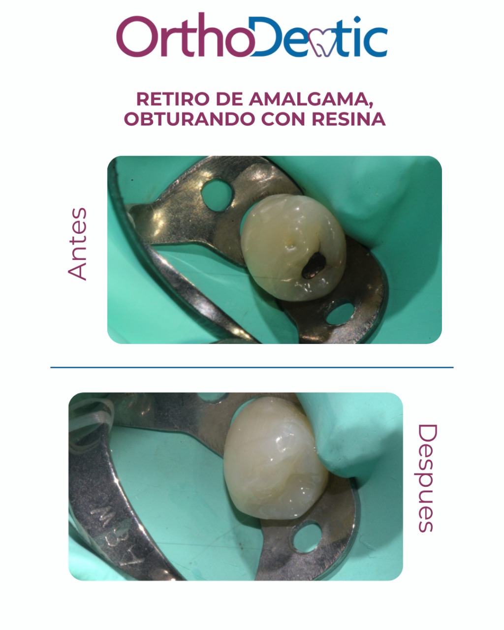 Retiro de amalgama, obturando con resina